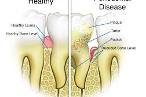 Gum Disease